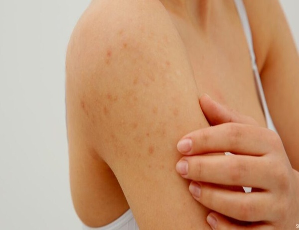 ما هي طرق إزالة بقع الحبوب من الجسم بوصفات طبيعية