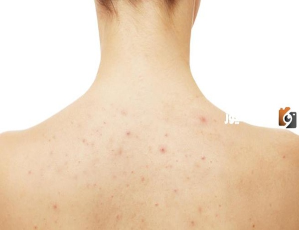 ما هي طرق إزالة بقع الحبوب من الجسم بوصفات طبيعية