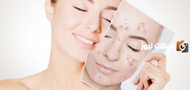 افضل طرق علاج حب الشباب للبشرة الدهنية بسرعة ونهائياً 2025