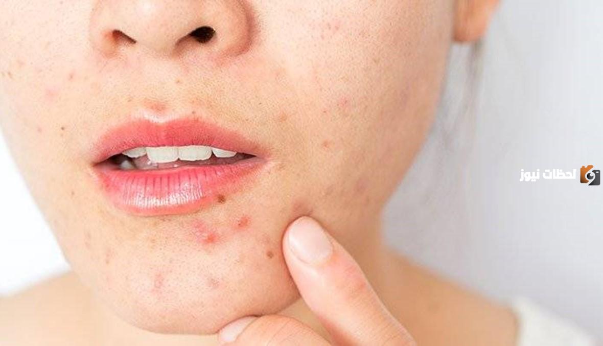أشهر طرق علاج حب الشباب للبشرة الدهنية بسرعة ونهائياً 