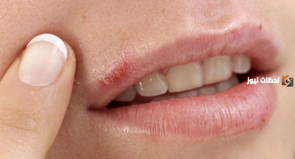 أسباب وعلاج مرض أبو حافور عند الأطفال pdf