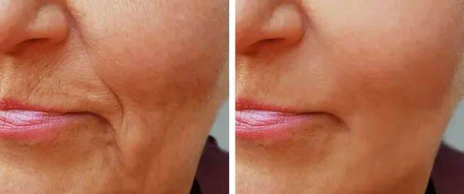 أهم طرق لإزالة التجاعيد بسرعة