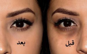 تجربتي في التخلص من تجاعيد العين