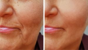 تجربتي مع تجاعيد حول الفم