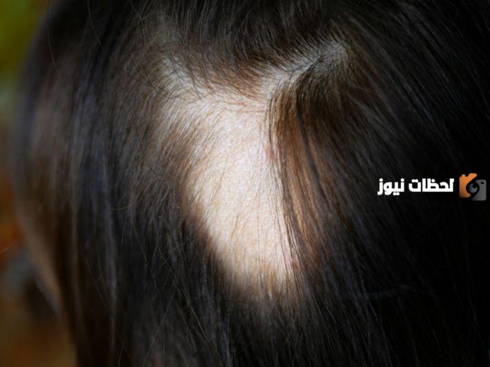 ما هى طريقة علاج الصلع المبكر عند النساء