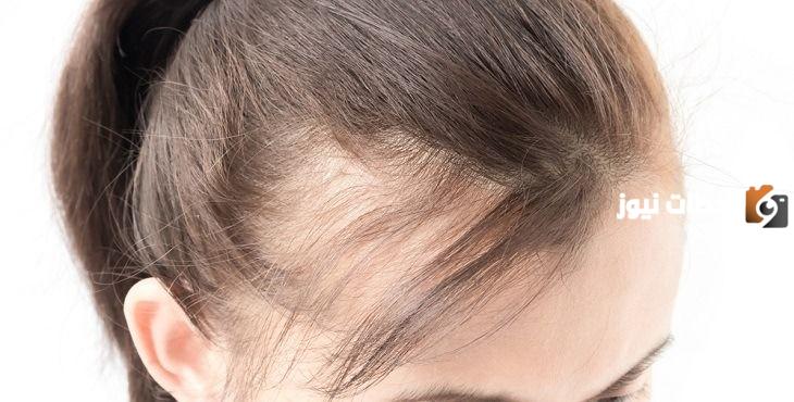 ما هى طريقة علاج الصلع المبكر عند النساء