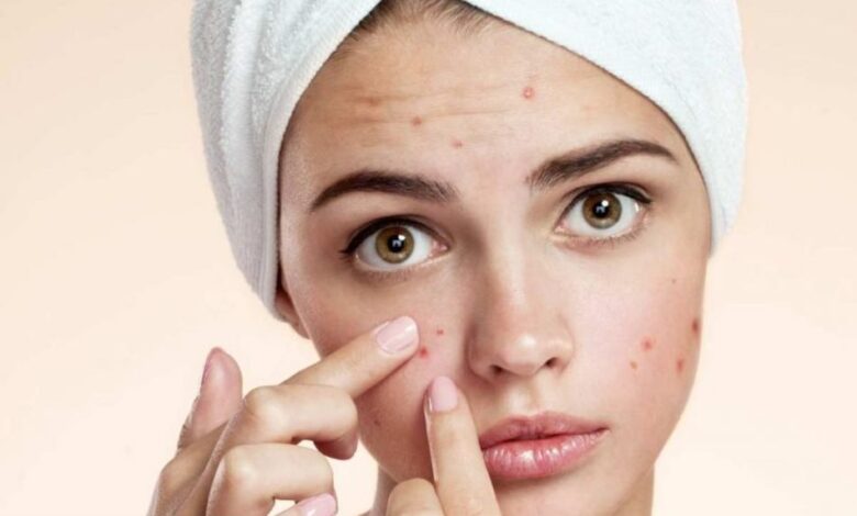 هذه أفضل كريمات علاج آثار حب الشباب وخلطات لحب الشباب