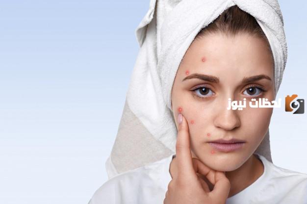 هذه أفضل كريمات علاج آثار حب الشباب وخلطات لحب الشباب
